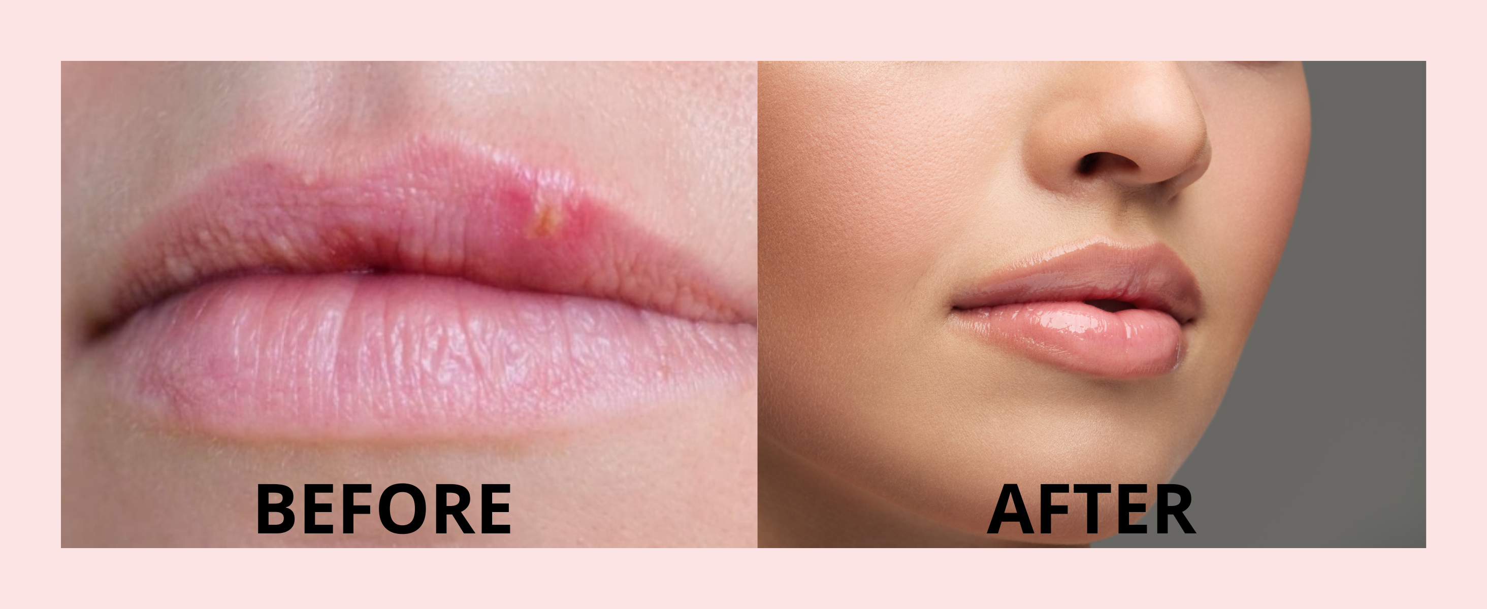Benefits of Using Specialized Creams for Fordyce Spots