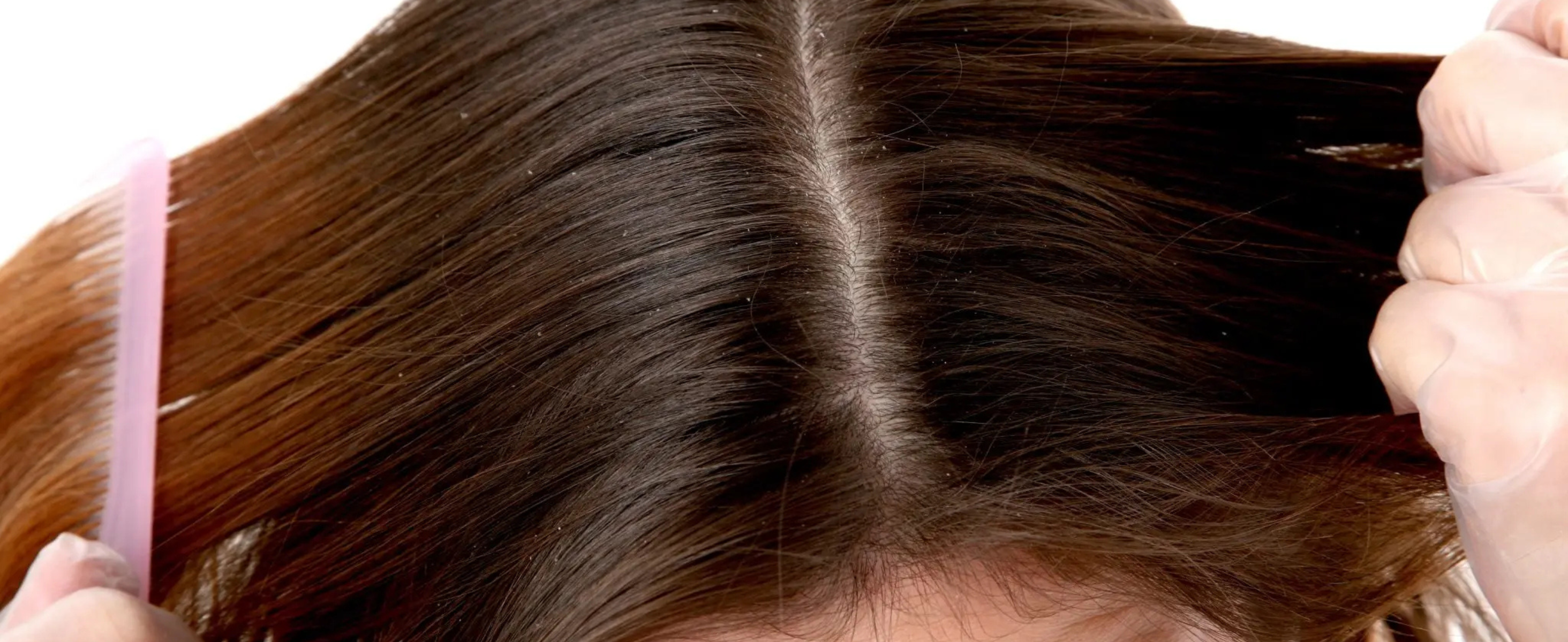 Top 5 Best Dandruff Shampoos for Women in 2024