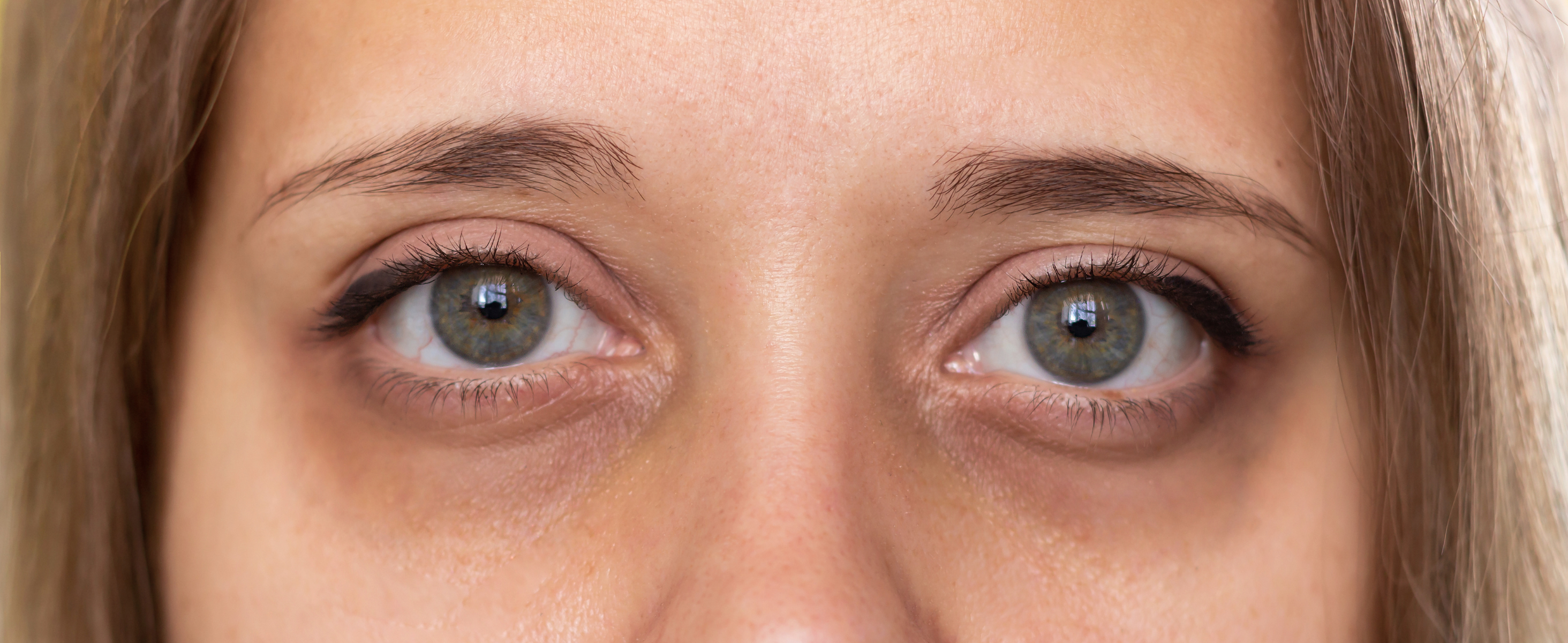 How to Get Rid of Dark Circles: Causes, Treatments & Prevention