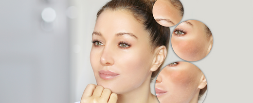 Understanding the Types of Hyperpigmentation and Effective Solutions