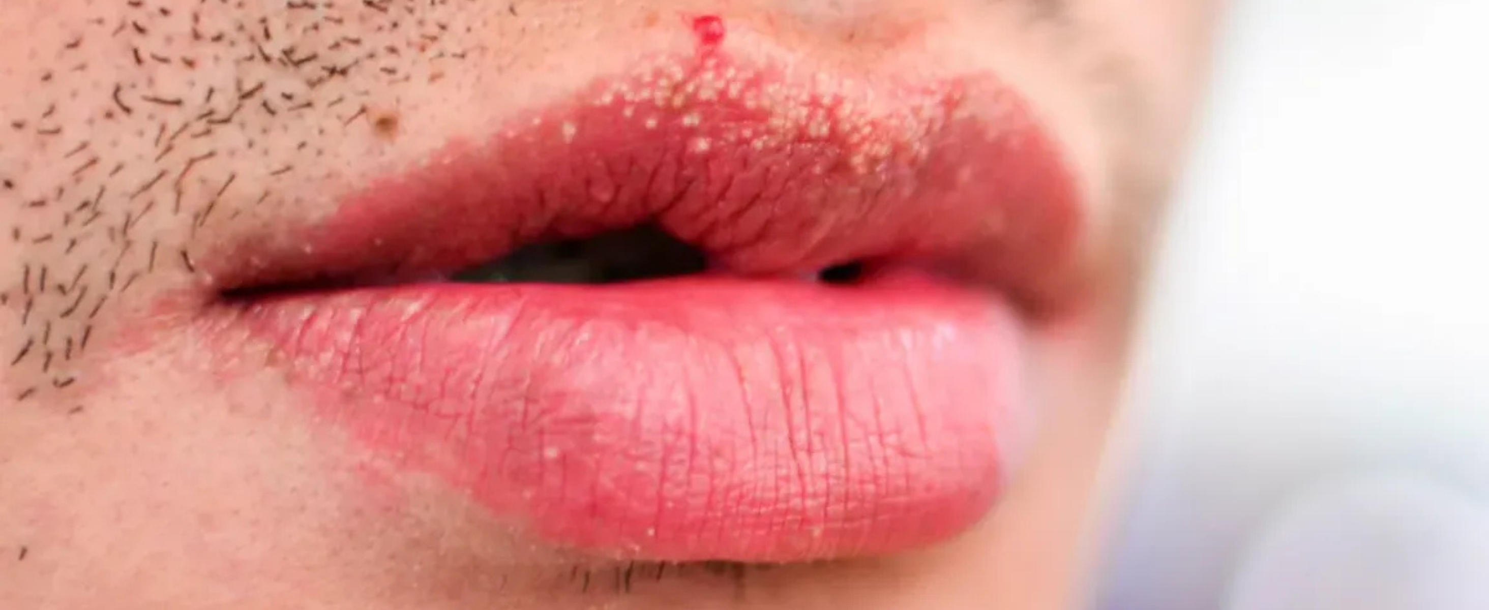 What Causes Fordyce Spots on Lips?