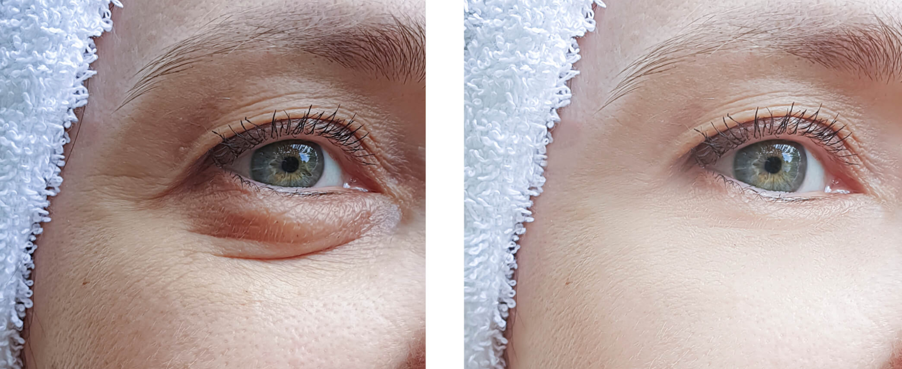 8 Effective Ways to Reduce Dark Circles Under Your Eyes
