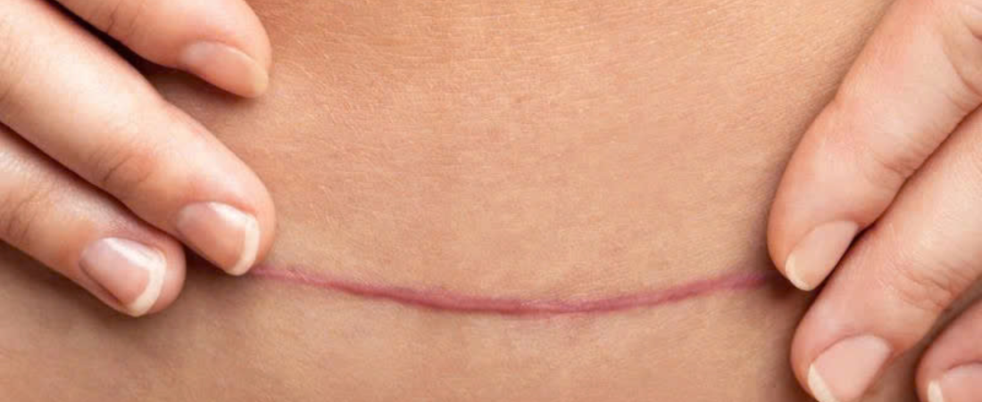Ways to Reduce Scars and Achieve More Even Skin