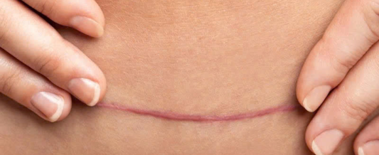 Ways to Reduce Scars and Achieve More Even Skin