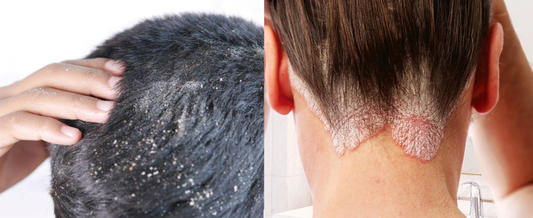 How to Reduce Dandruff & Support a Healthier Scalp Naturally