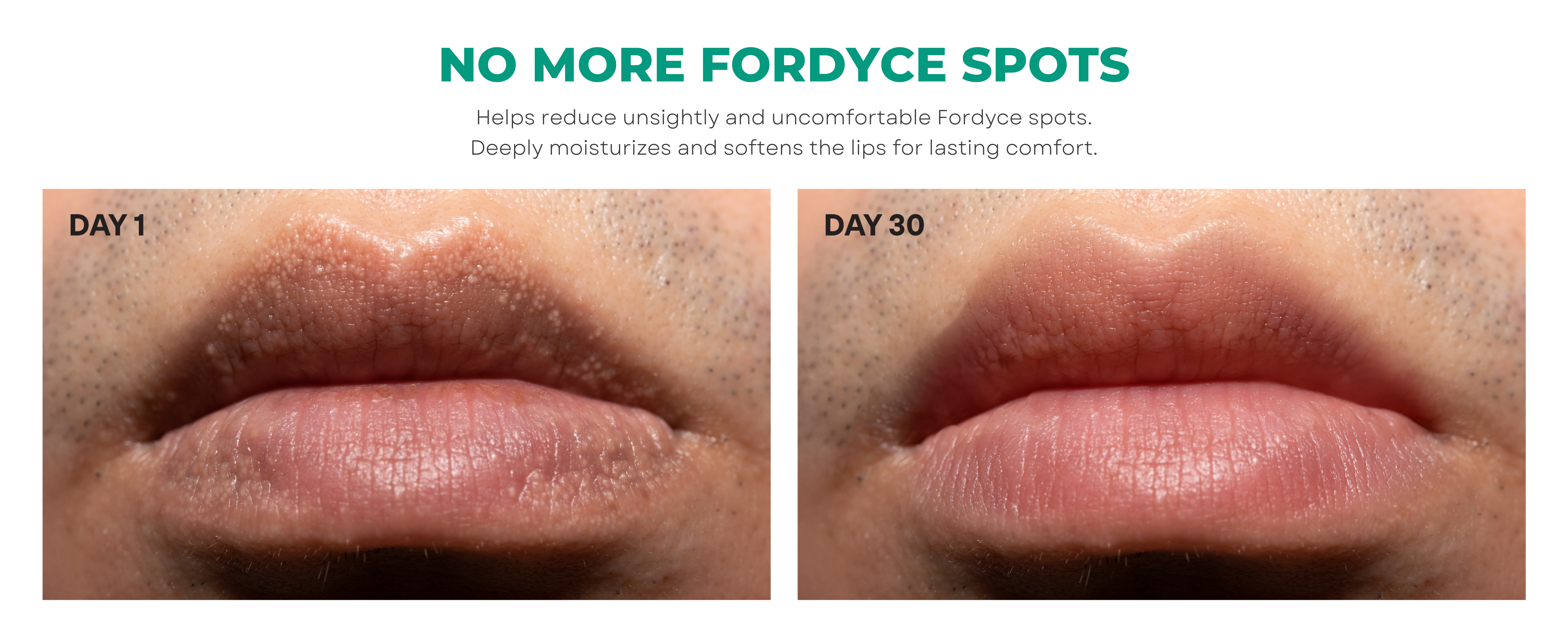 Fordyce Spots Removal Cream