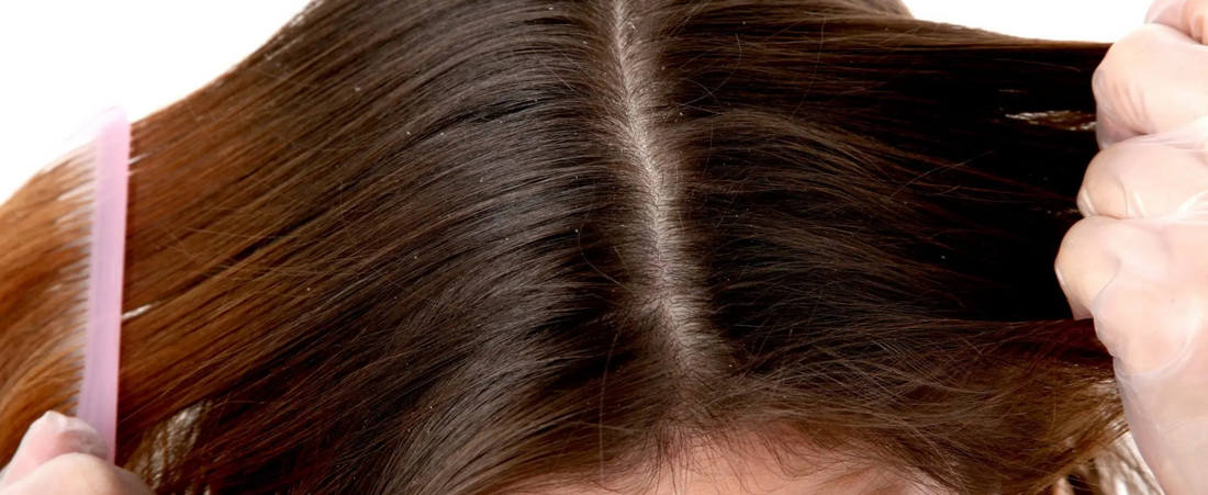 Top 5 Best Dandruff Shampoos for Women in 2024
