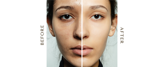 5 Essential Morning Skincare Steps to Reduce Melasma