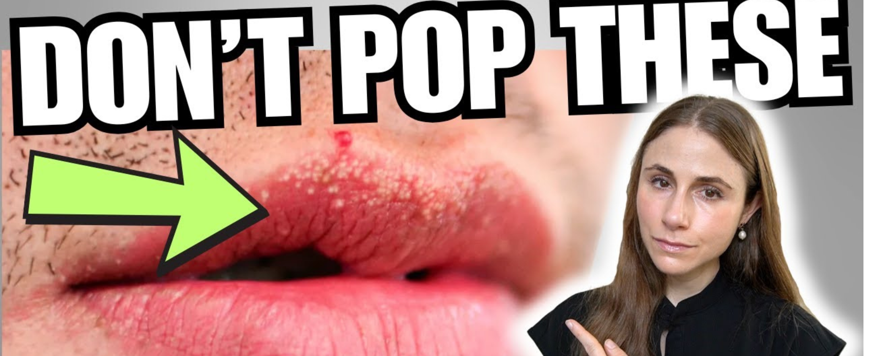 Fordyce Spots vs Cold Sores: How to Tell the Difference