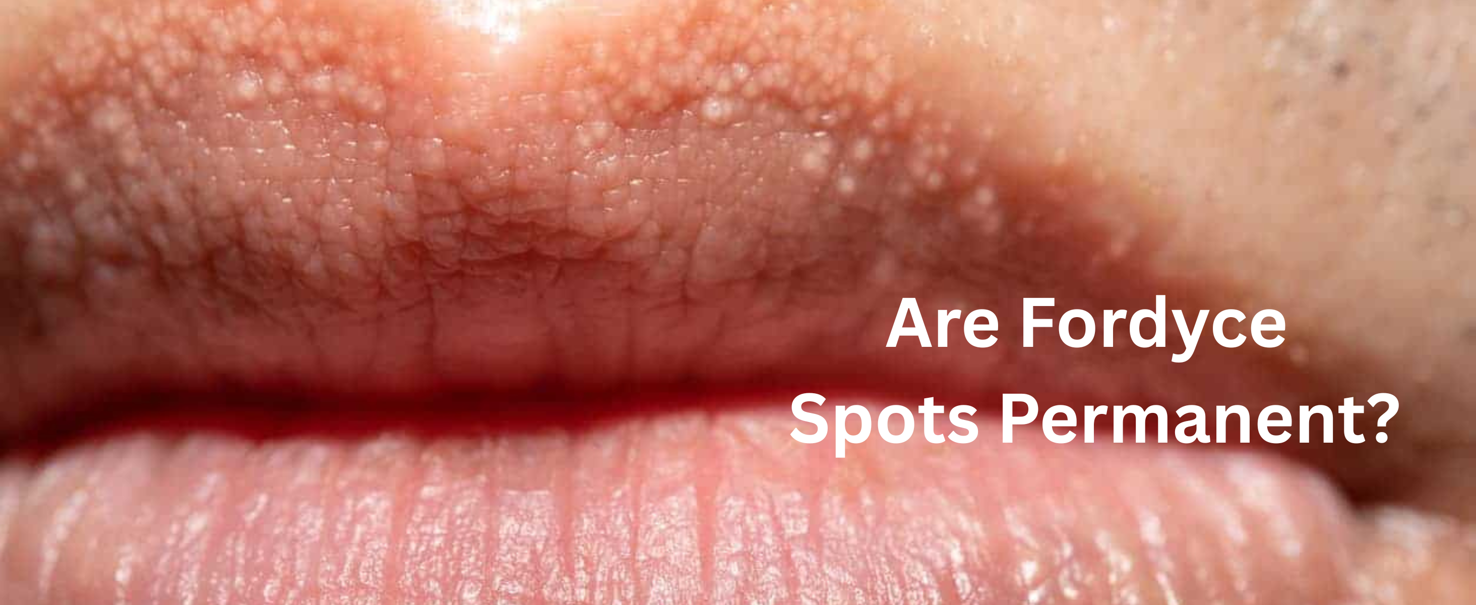 Are Fordyce Spots Permanent? What You Need to Know