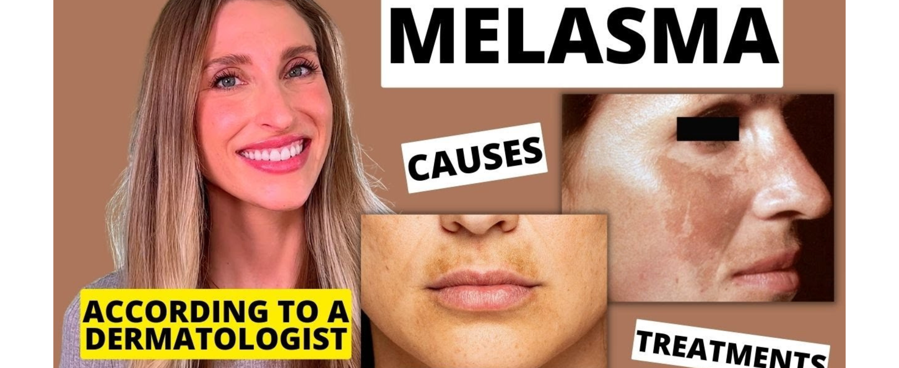 A Simple Guide to Improving Melasma for Brighter, More Even Skin