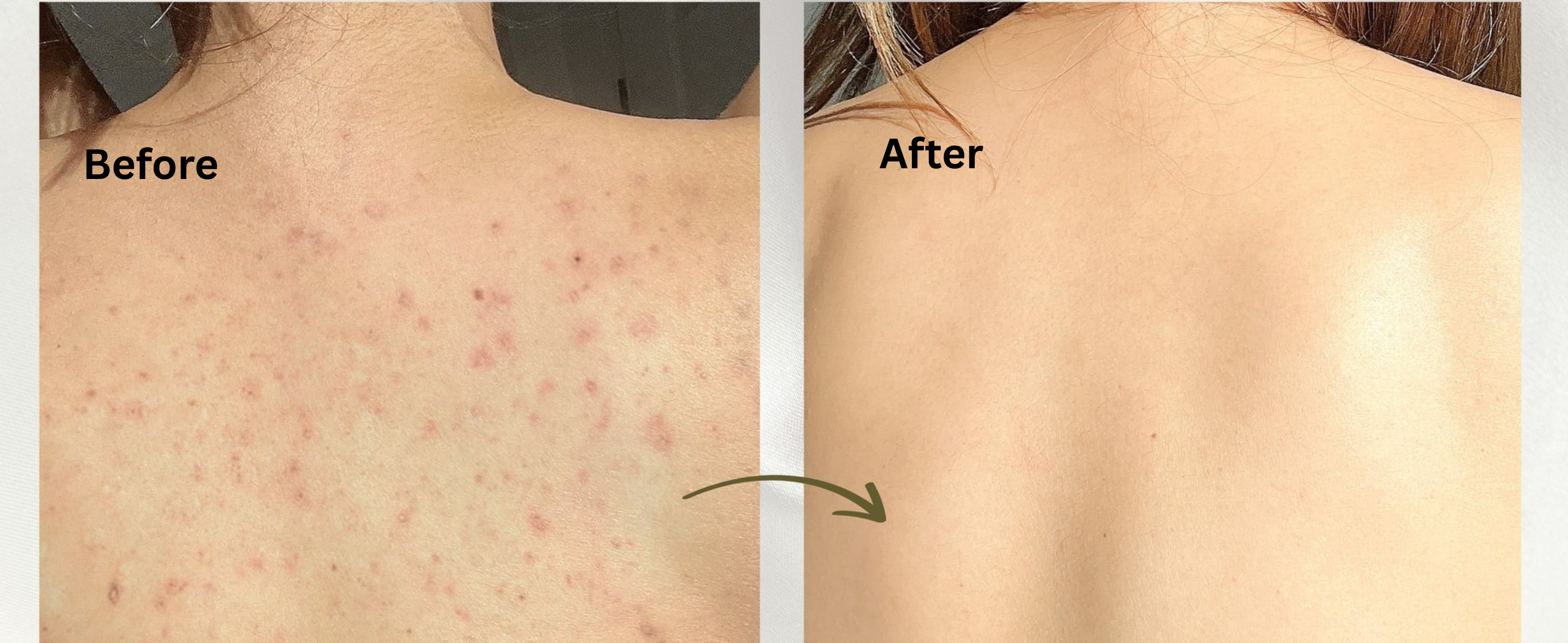 🌿 How to Treat Back Acne &amp; Folliculitis Naturally: A Gentle Body Care Routine