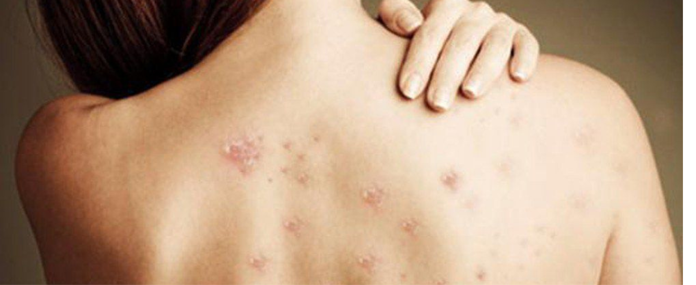 Back Acne vs. Folliculitis: What’s the Difference and How to Treat Them Effectively