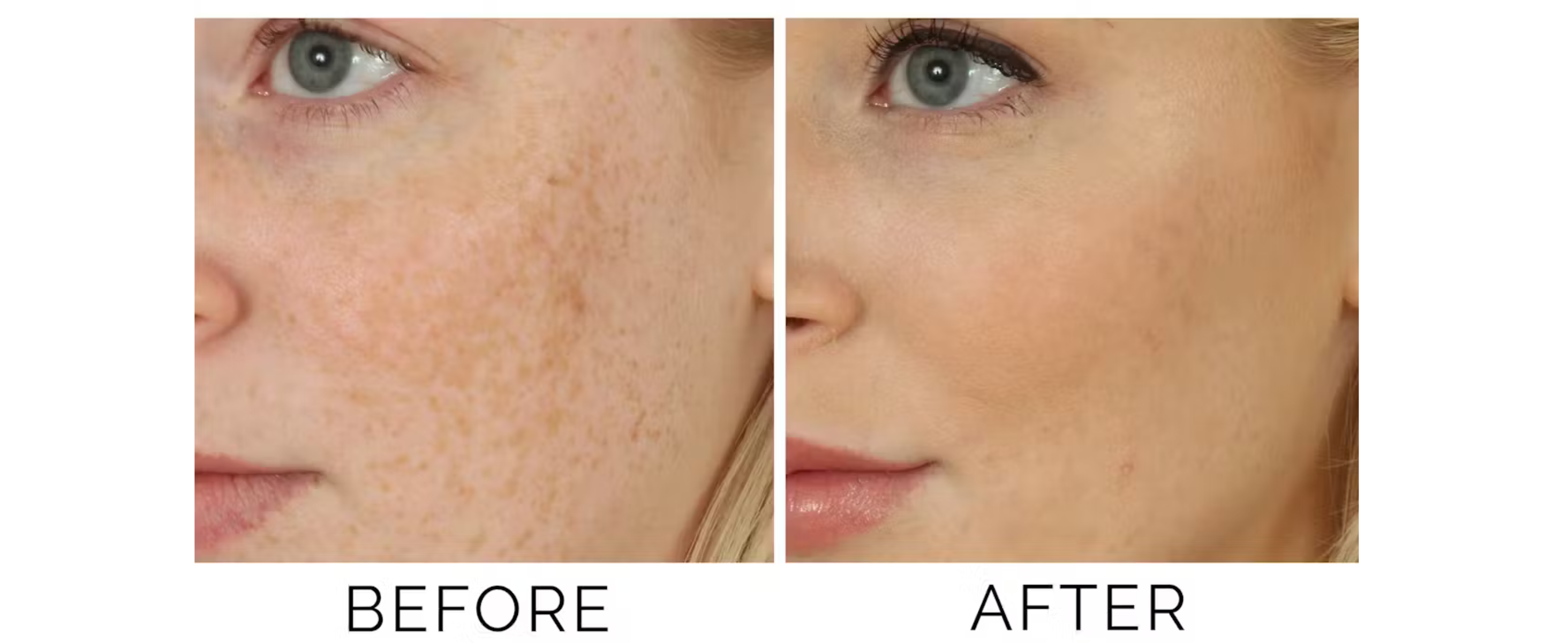 The Best Skincare Routine for Melasma