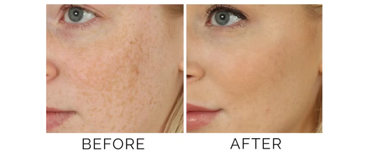 The Best Skincare Routine for Melasma