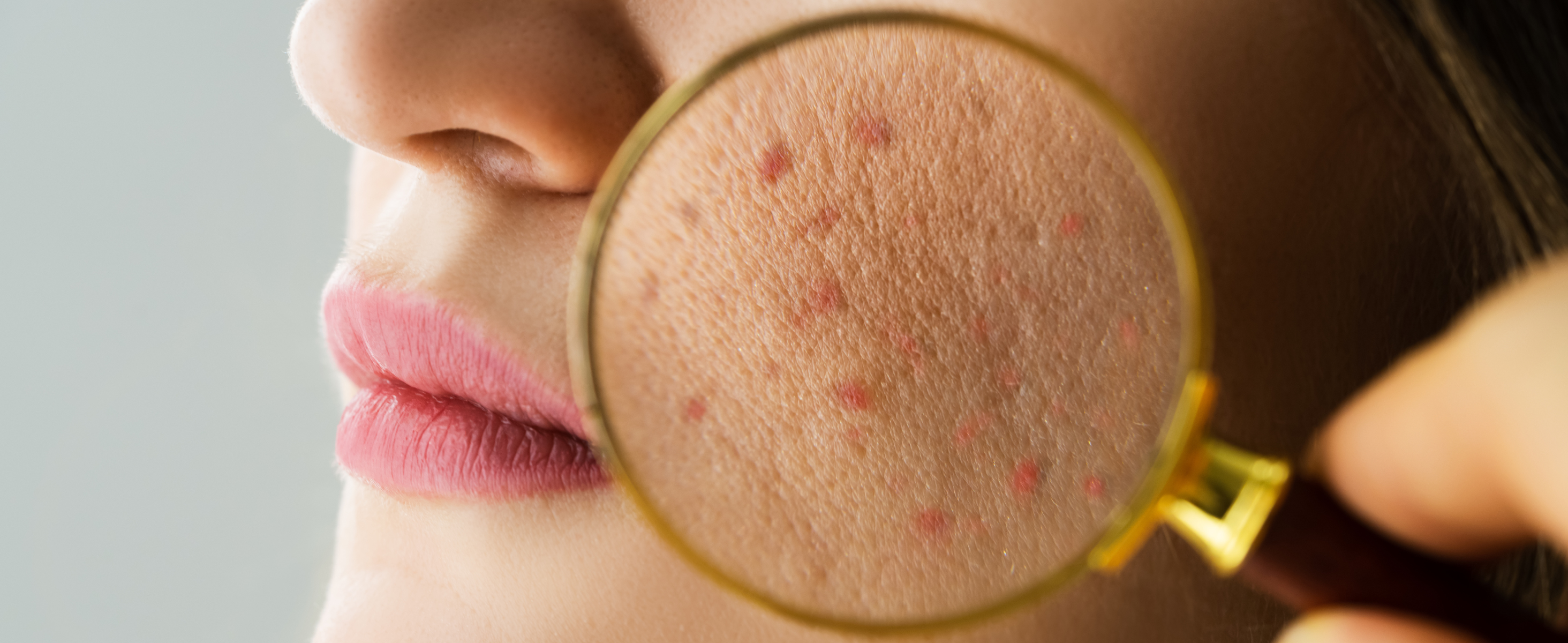 Can Retinol Really Clear Your Acne?