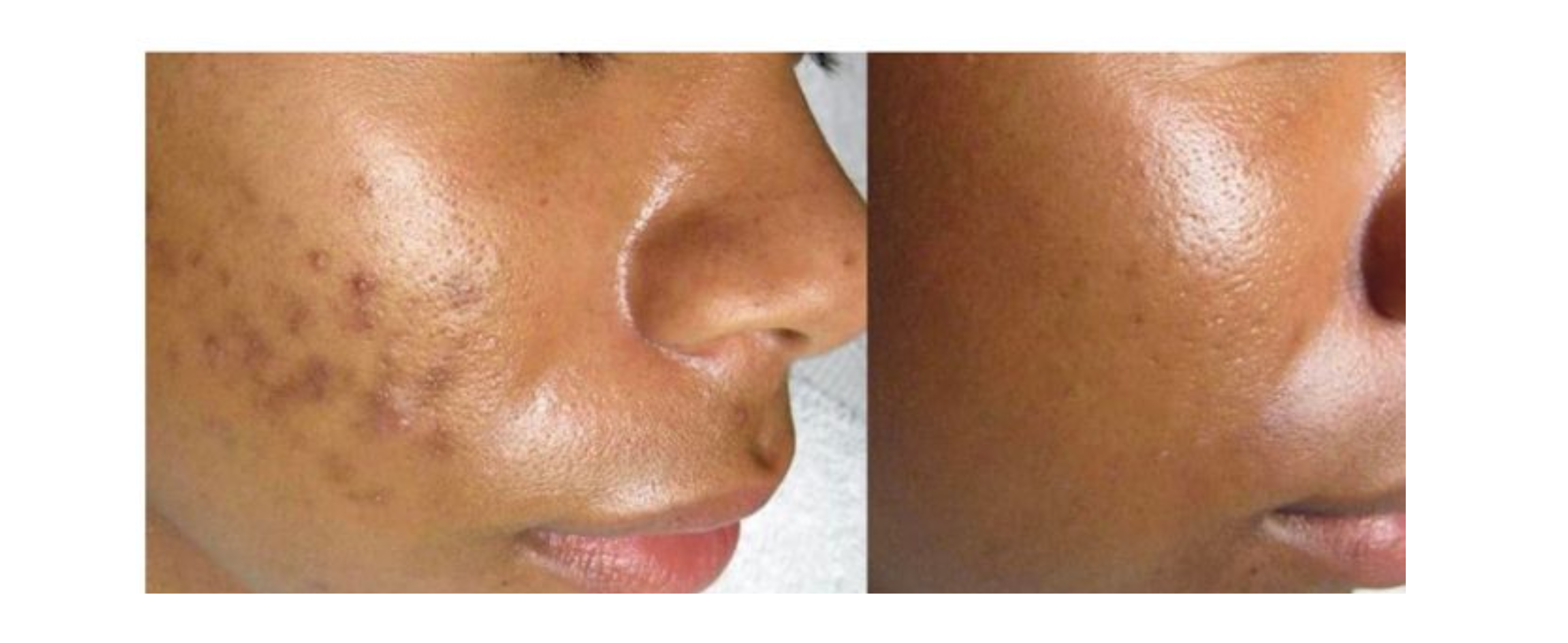 How To Get Rid Of Dark Spots Naturally For Black Skin – Abera.us