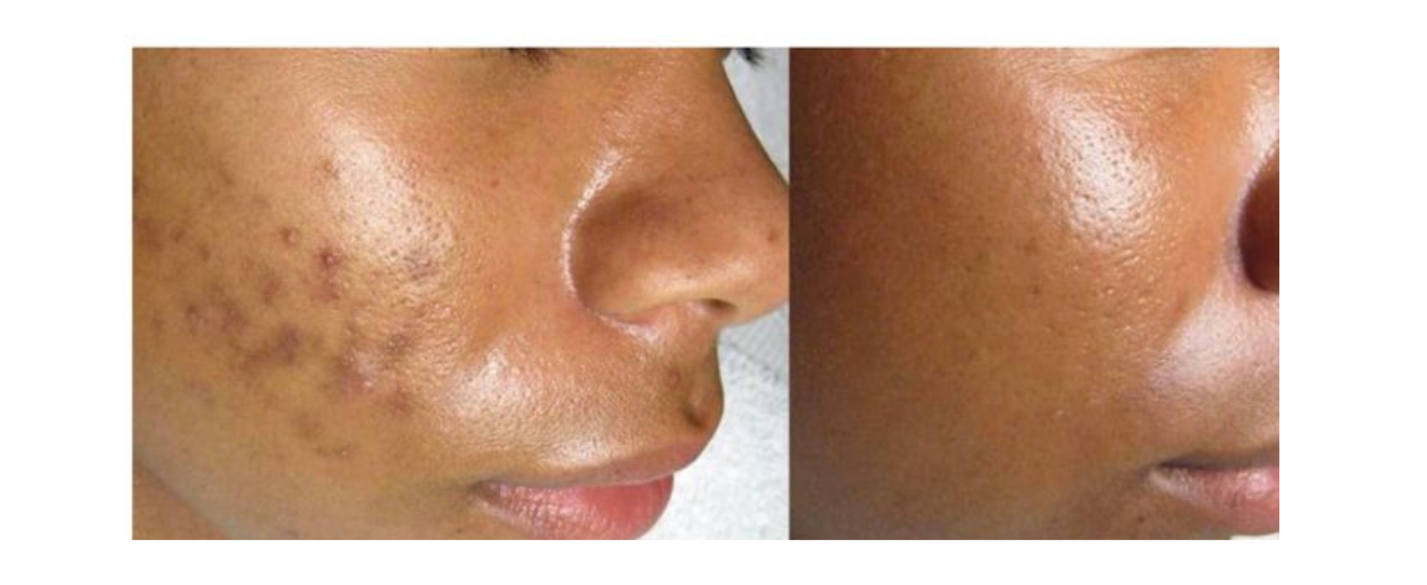 How To Get Rid Of Dark Spots Naturally For Black Skin