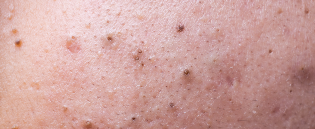 How to Get Rid of Blackheads: Causes, Treatments, and Prevention Tips