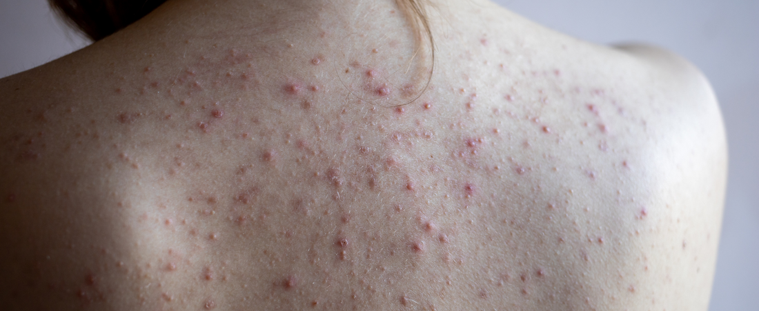 Folliculitis vs. Body Acne: The Best Body Wash for Each