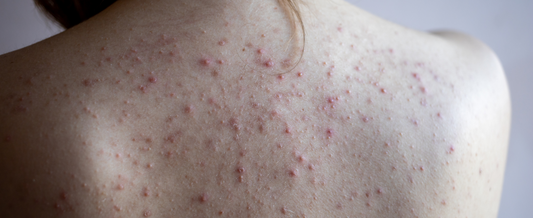 Folliculitis vs. Body Acne: The Best Body Wash for Each