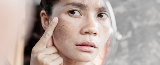 5 Natural Remedies to Effectively Treat Dark Spots