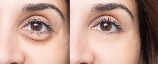 Under-Eye Puffiness: What It Is and How to Treat It