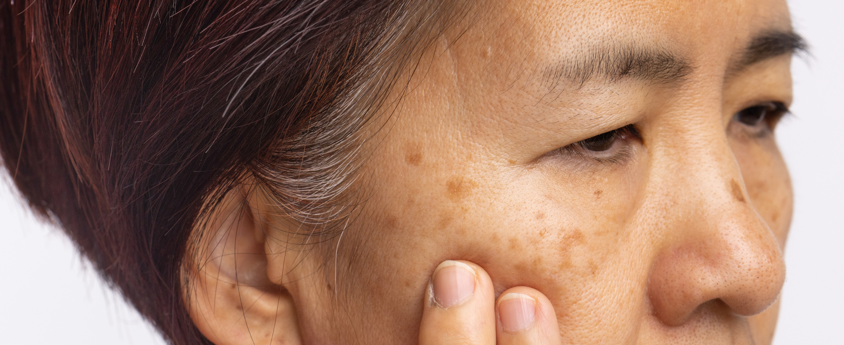 What Is Melasma? Causes, Symptoms & How to Treat It Effectively