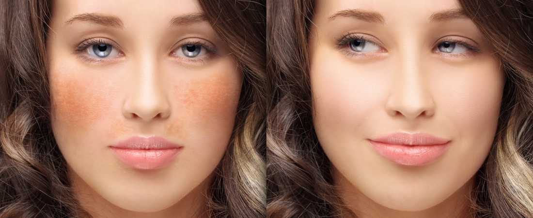 Top 5 Ingredients Dermatologists Recommend for Dark Spots & Melasma