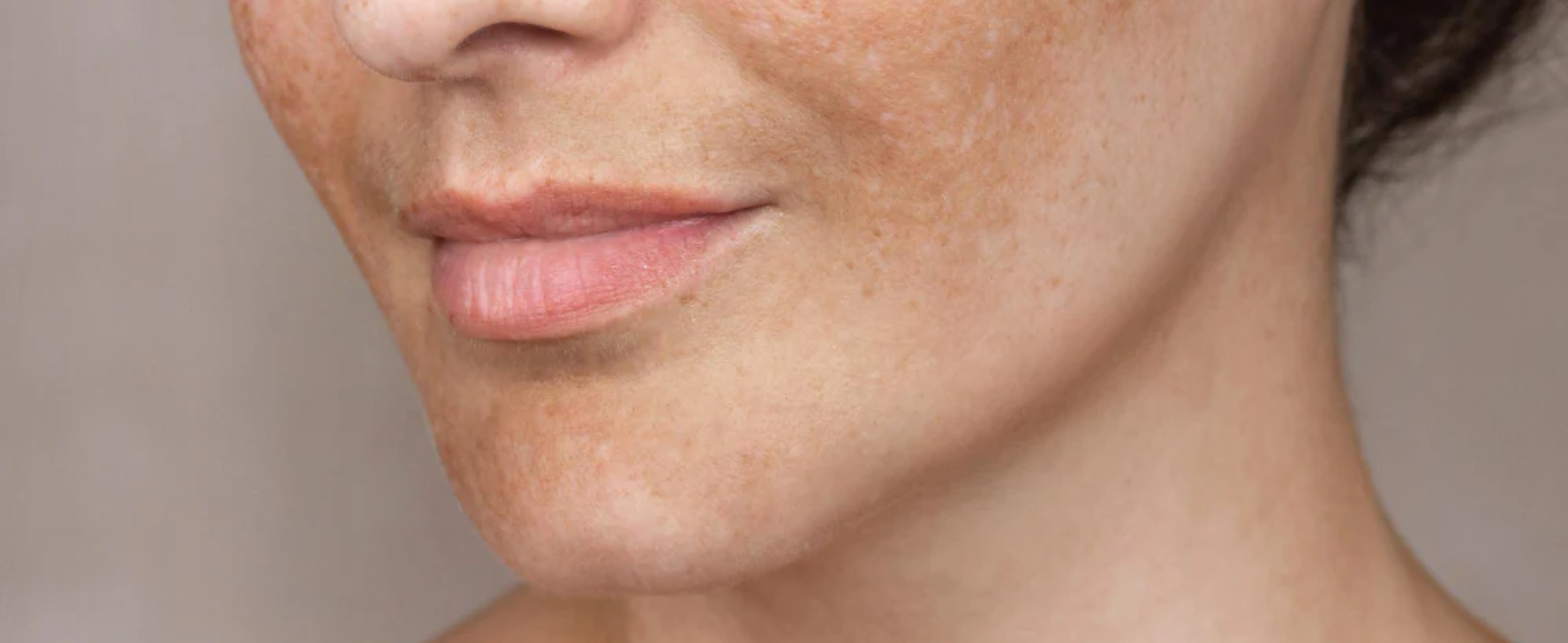 Can Melasma Be Permanently Removed?