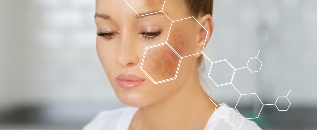 Melasma During Pregnancy: Causes And Treatment Options