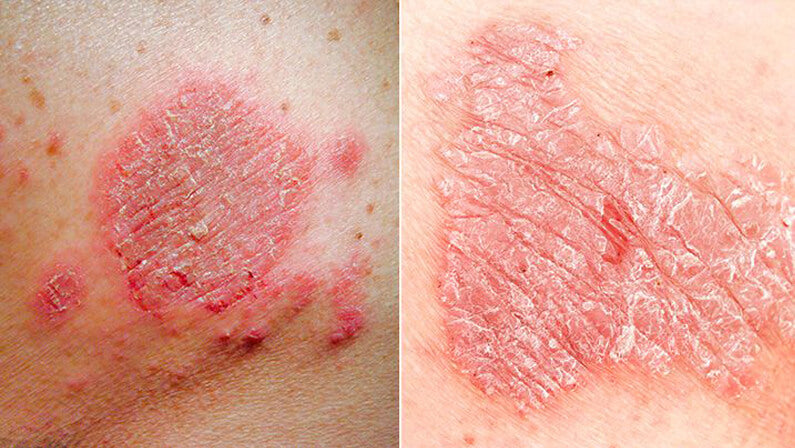 Psoriasis vs. Eczema: Understanding the Difference and How to Manage T ...