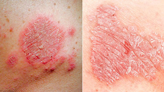 Psoriasis vs. Eczema: Understanding the Difference and How to Manage Them
