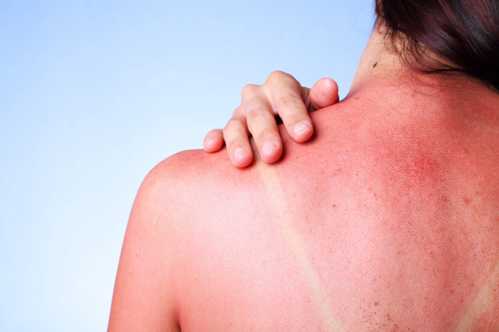 What Happens to Your Skin After Too Much Sun Exposure?