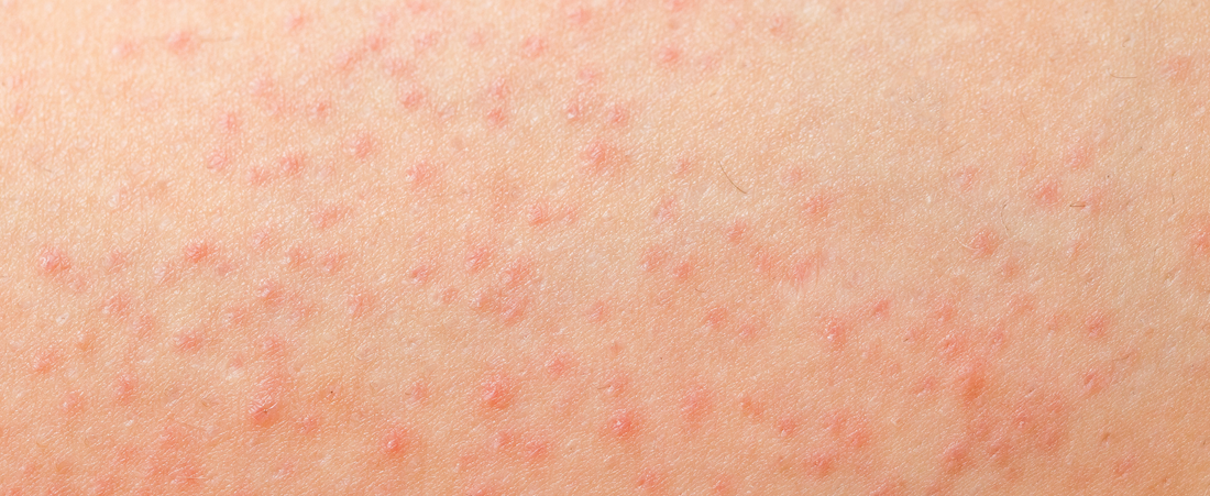How to Get Rid of Body Acne Naturally and Effectively