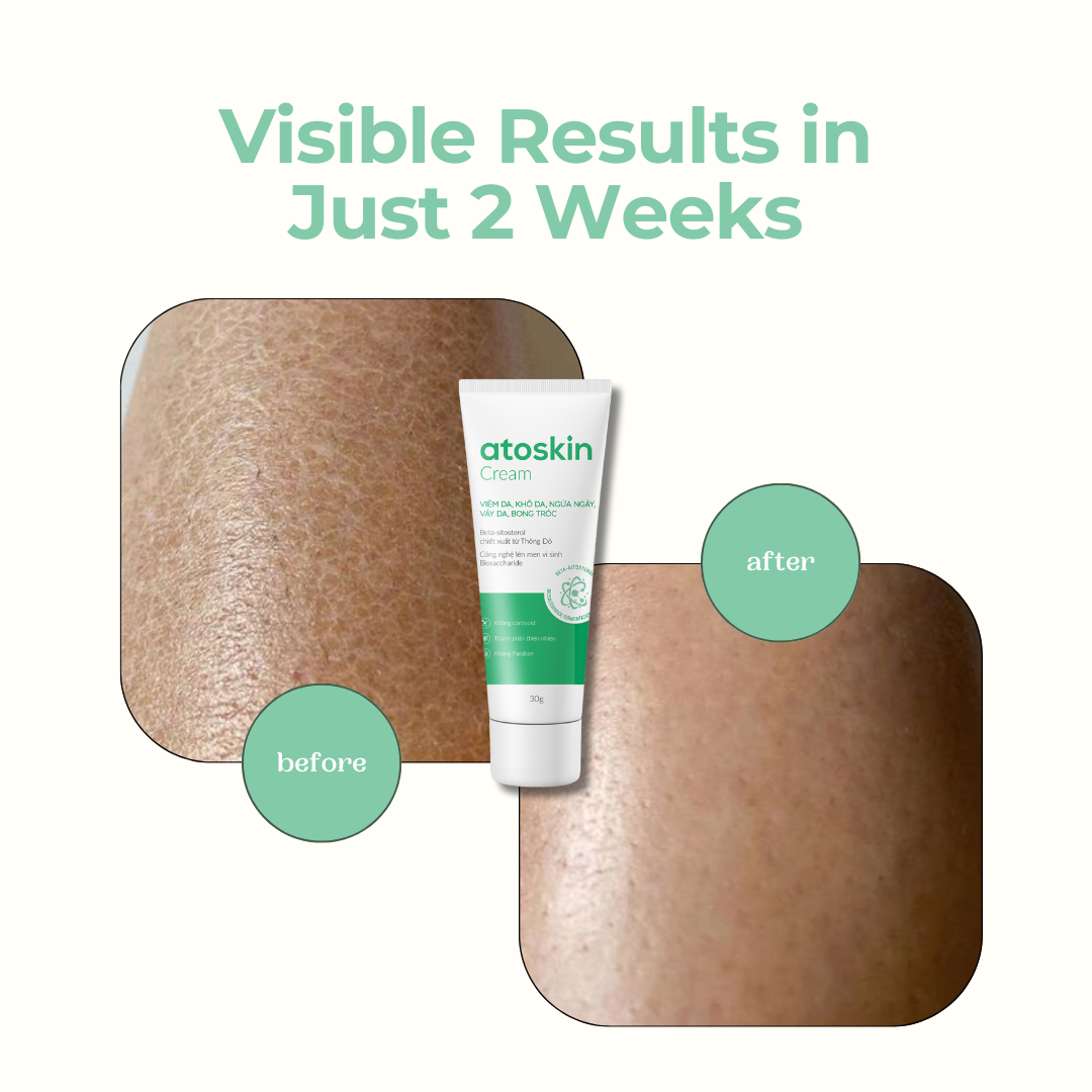 Atoskin Cream, Eczema Cream, Soothing Lotion for Psoriasis, Folliculitis (1.01 Oz)