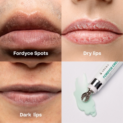 Abera Fordyce Cream For Lips – Hydrating & Healing Formula with Activoil Spotless