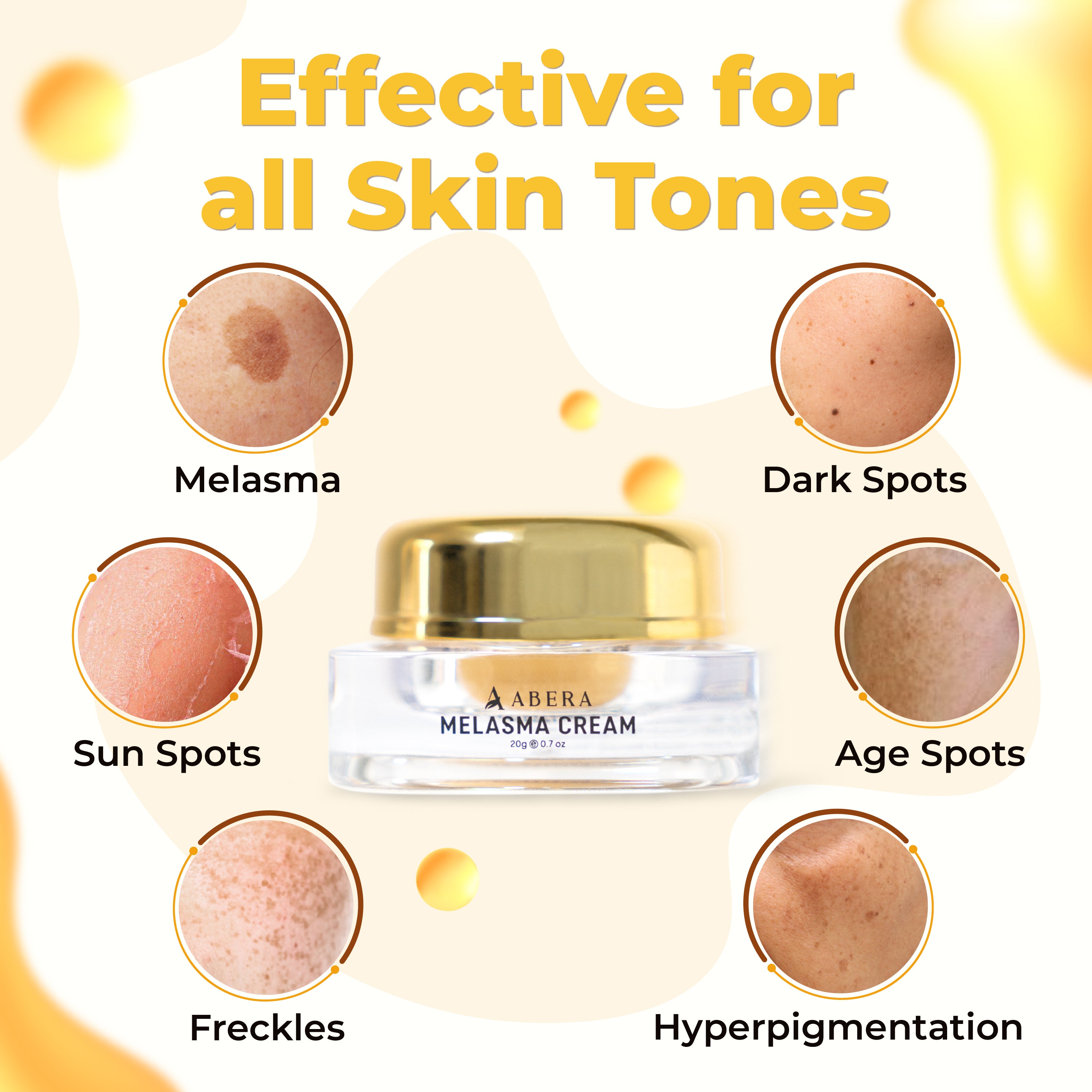 BLACK FRIDAY 70% - ABERA Melasma Cream 20ml (Premium Version