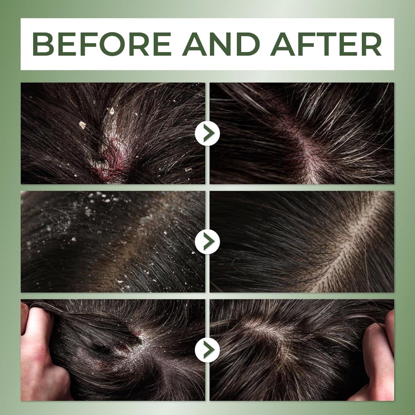 ABERA Powerful Anti-Dandruff Shampoo with Pure Langbian Ginseng