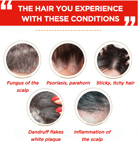 dandruff scalp fungus